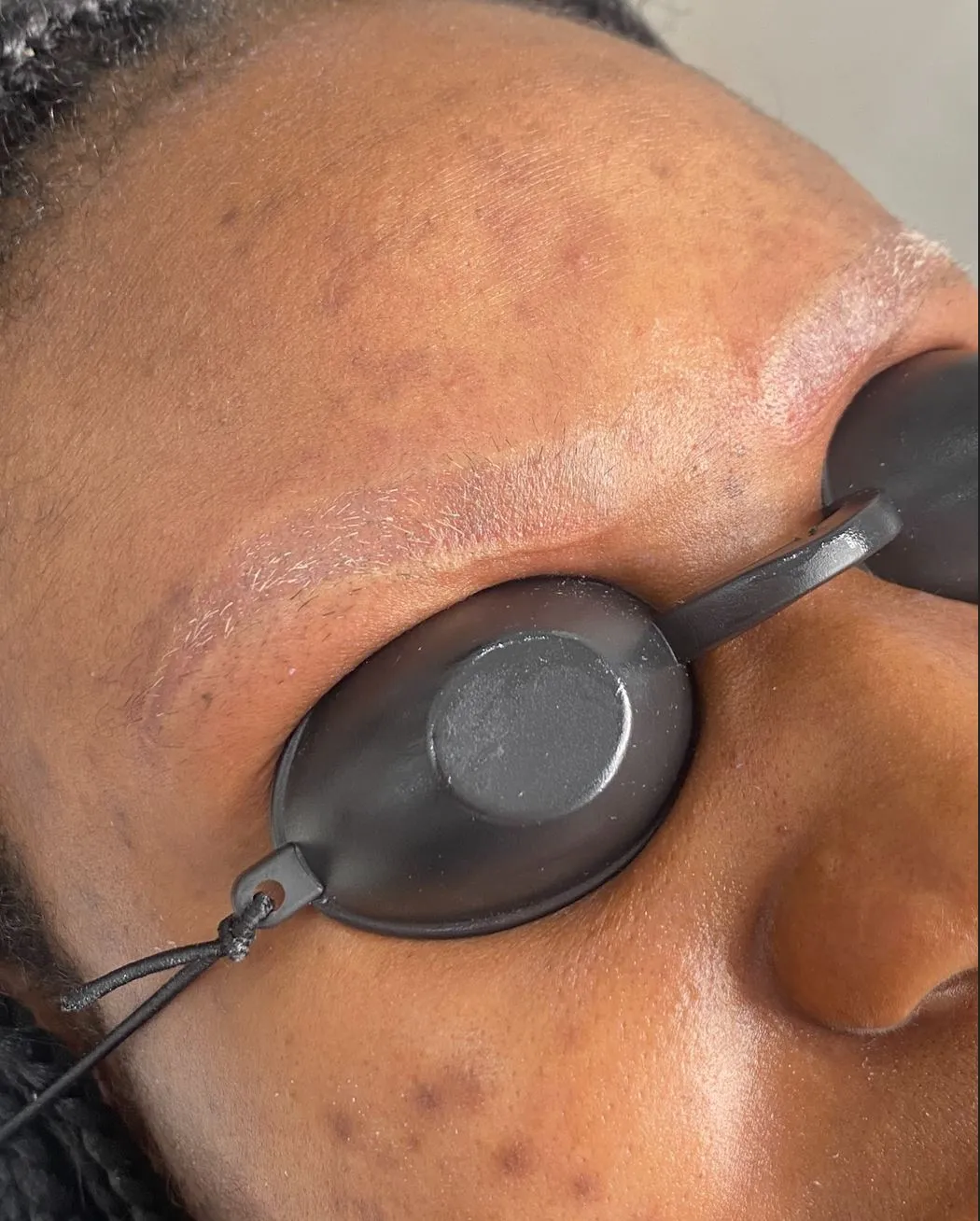eyebrow tattoo removal